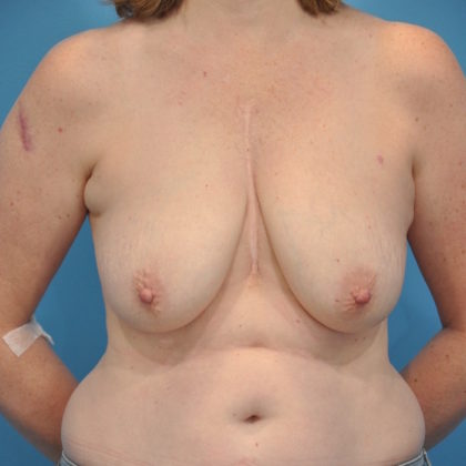 Implant Reconstruction Before & After Patient #257