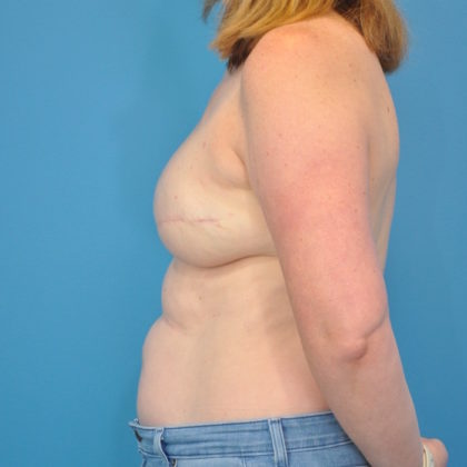 Implant Reconstruction Before & After Patient #257