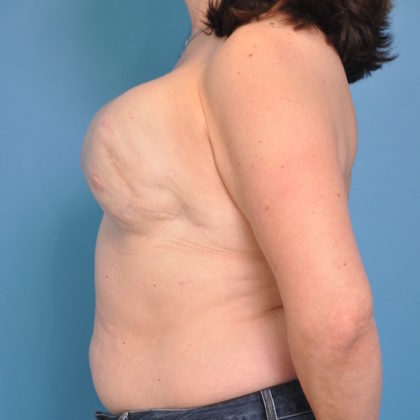 Autologous/DIEP Flap Reconstruction Before & After Patient #246