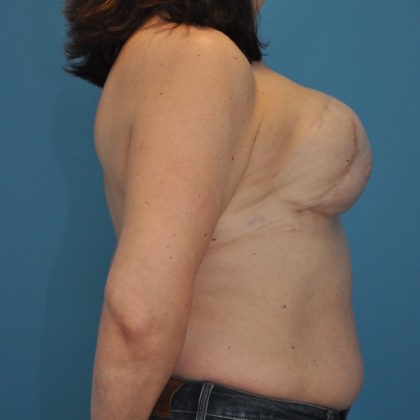 Autologous/DIEP Flap Reconstruction Before & After Patient #246