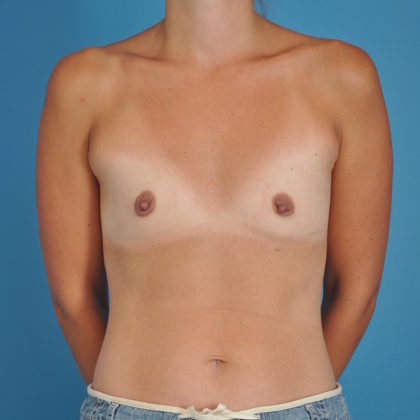 Breast Augmentation Before & After Patient #221
