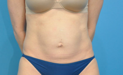 Abdominoplasty/ Tummy Tuck Before & After Patient #159