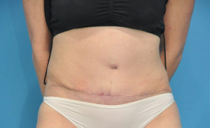 Abdominoplasty/ Tummy Tuck Before & After Patient #159