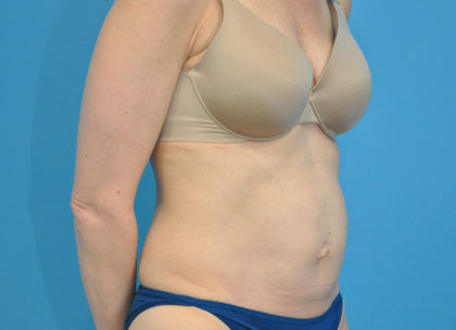 Abdominoplasty/ Tummy Tuck Before & After Patient #159