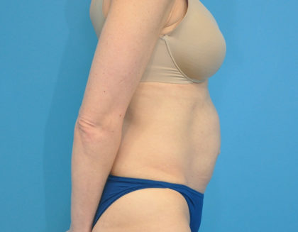 Abdominoplasty/ Tummy Tuck Before & After Patient #159