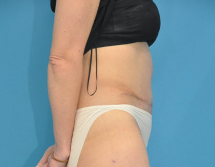 Abdominoplasty/ Tummy Tuck Before & After Patient #159
