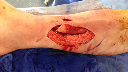 Complex Microsurgical Reconstruction Before & After Patient #292