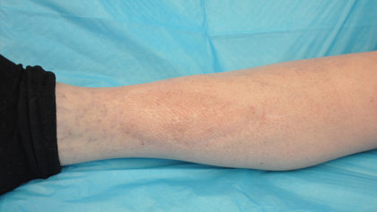 Complex Microsurgical Reconstruction Before & After Patient #292