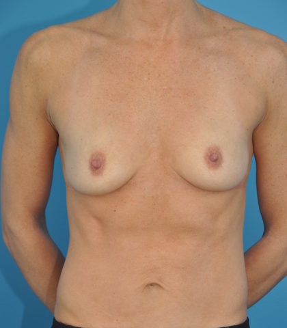 Implant Reconstruction Before & After Patient #264