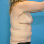 Body Contouring Before & After Patient #175