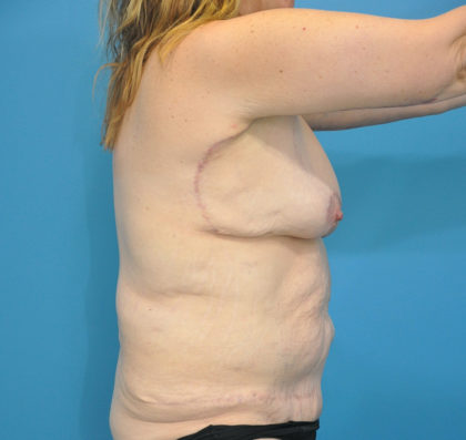 Body Contouring Before & After Patient #175