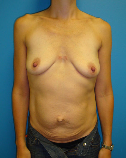 Abdominoplasty/ Tummy Tuck Before & After Patient #166