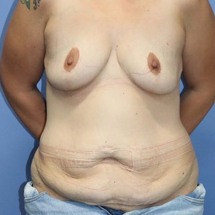 Abdominoplasty/ Tummy Tuck Before & After Patient #645