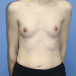 Breast Augmentation Before & After Patient #647