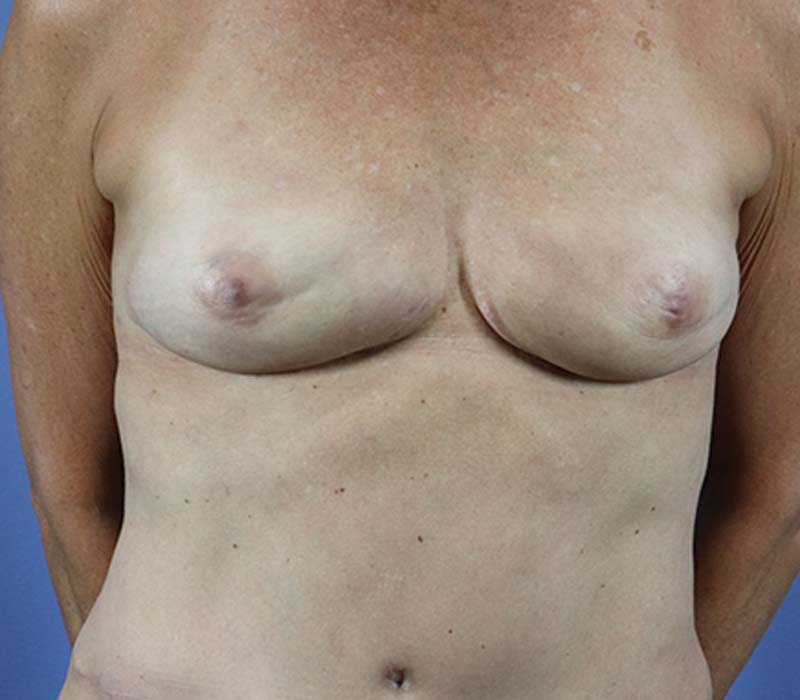 Autologous/DIEP Flap Reconstruction Before & After Patient #682