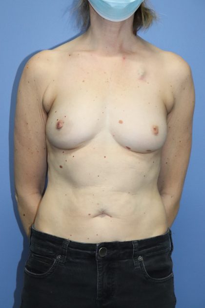 Abdominal Results Patients Can Expect After DIEP Flap Breast