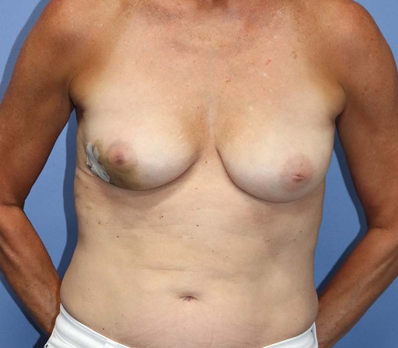 Autologous/DIEP Flap Reconstruction Before & After Patient #682