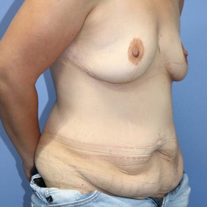 Abdominoplasty/ Tummy Tuck Before & After Patient #645