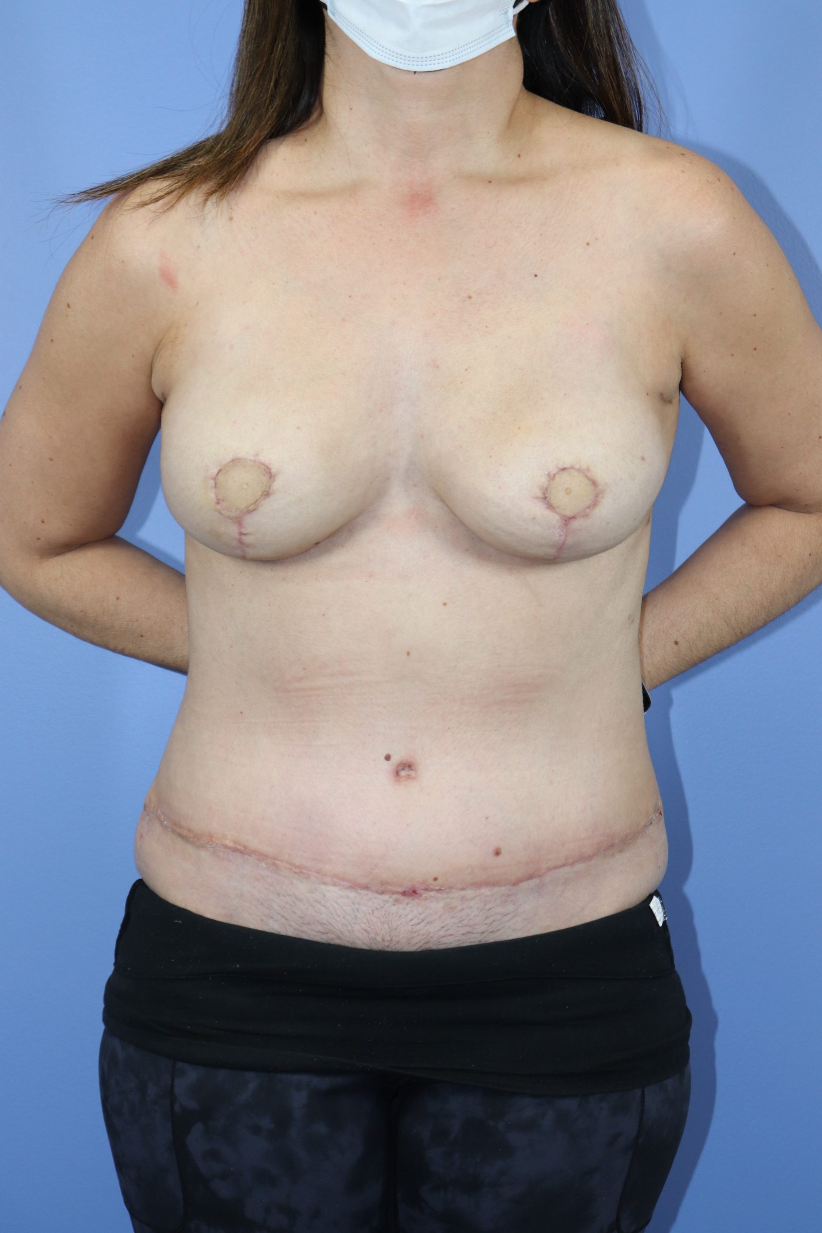 Autologous/DIEP Flap Reconstruction Before & After Patient #630