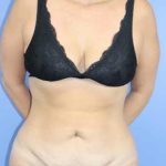 Body Before and After Photos Lake Forest - Plastic Surgery Gallery Chicago,  IL - Dr. Michael Howard
