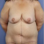 Breast Lift Before & After Patient #813