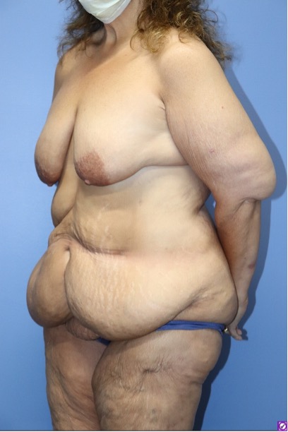 Breast Lift Before & After Patient #813