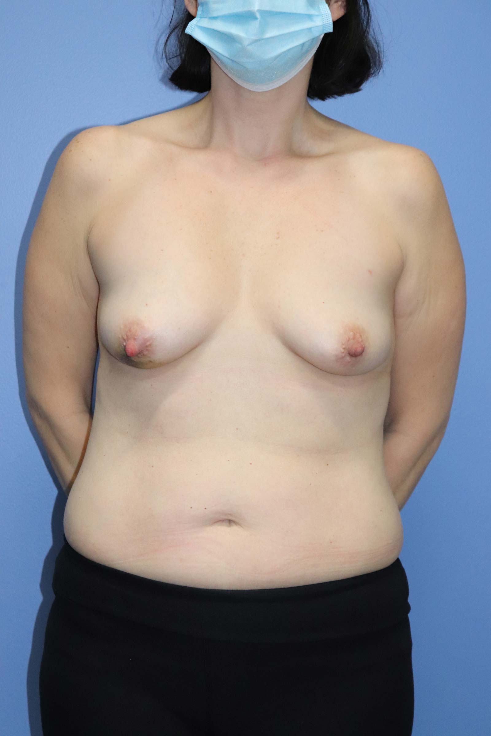Autologous/DIEP Flap Reconstruction Before & After Patient #831