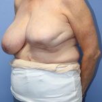 Breast Reduction Before & After Patient #783