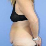 Abdominoplasty/ Tummy Tuck Before & After Patient #796