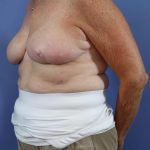 Breast Reduction Before & After Patient #783