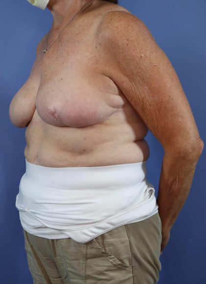 Patient #864 Autologous/DIEP Flap Reconstruction Before and After Photos  Lake Forest - Plastic Surgery Gallery Chicago, IL - Dr. Michael Howard