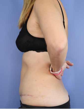 Abdominoplasty/ Tummy Tuck Before & After Patient #796