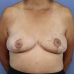 Autologous/DIEP Flap Reconstruction Before & After Patient #838