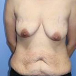 Autologous/DIEP Flap Reconstruction Before & After Patient #838