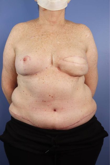 Patient #857 Autologous/DIEP Flap Reconstruction Before and After Photos  Lake Forest - Plastic Surgery Gallery Chicago, IL - Dr. Michael Howard