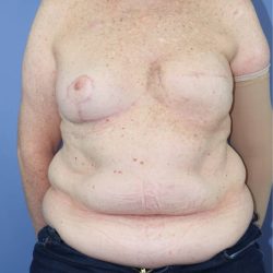 Autologous/DIEP Flap Reconstruction Before & After Patient #857
