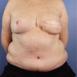 Autologous/DIEP Flap Reconstruction Before & After Patient #857