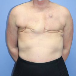 Autologous/DIEP Flap Reconstruction Before & After Patient #913