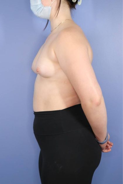 Breast Augmentation Before & After Patient #920