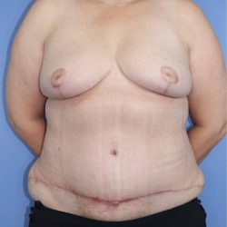 Breast Reduction Before & After Patient #906