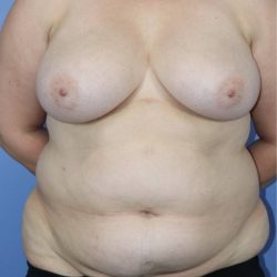 Breast Reduction Before & After Patient #906