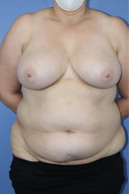 Breast Reduction Before & After Patient #906