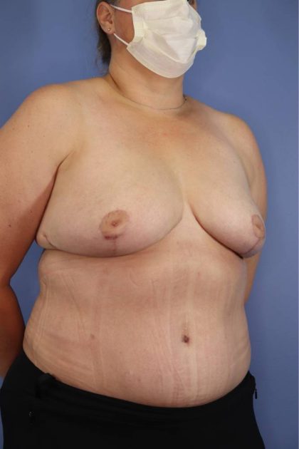 Breast Reduction Before & After Patient #906