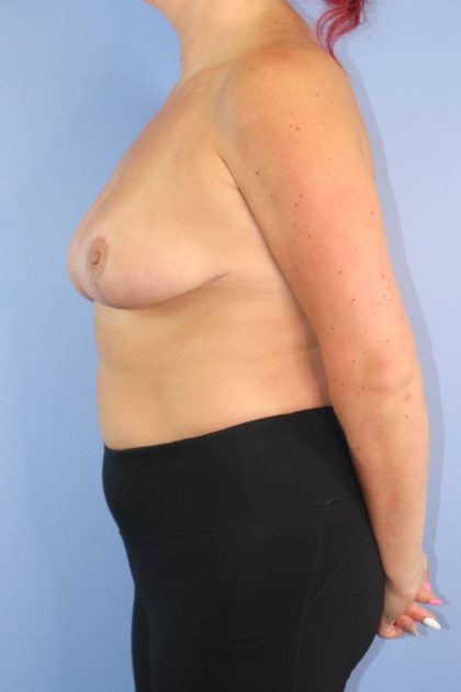 Breast Reduction Before & After Patient #899